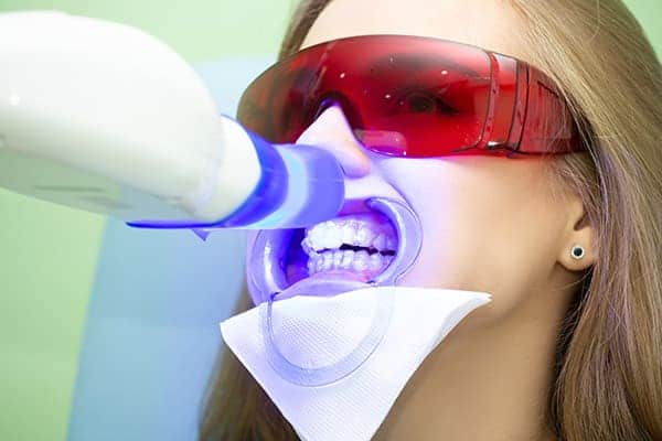 Laser teeth whitening treatments Aylesbury