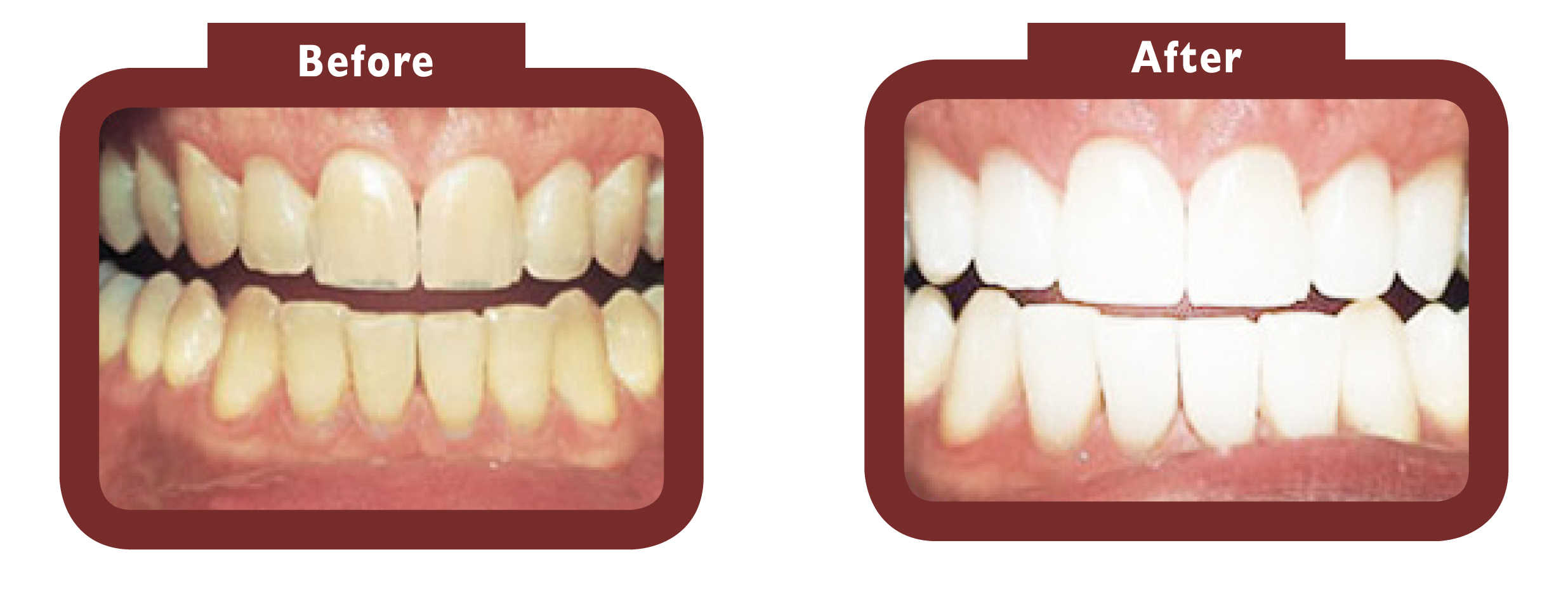 before and after teeth whitening - LA TEETH Aylesbury