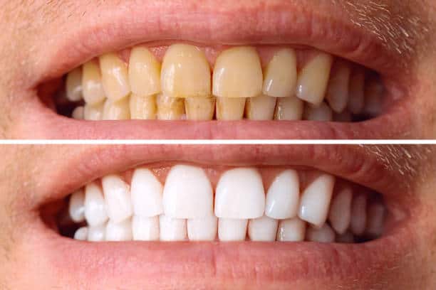 Laser White For Ever Bright – Get a Brighter, Whiter Smile with LA Teeth Whitening Aylesbury