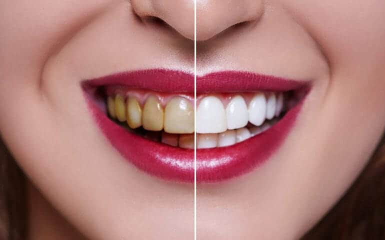 Teeth Whitening Ascot Windsor Aylesbury