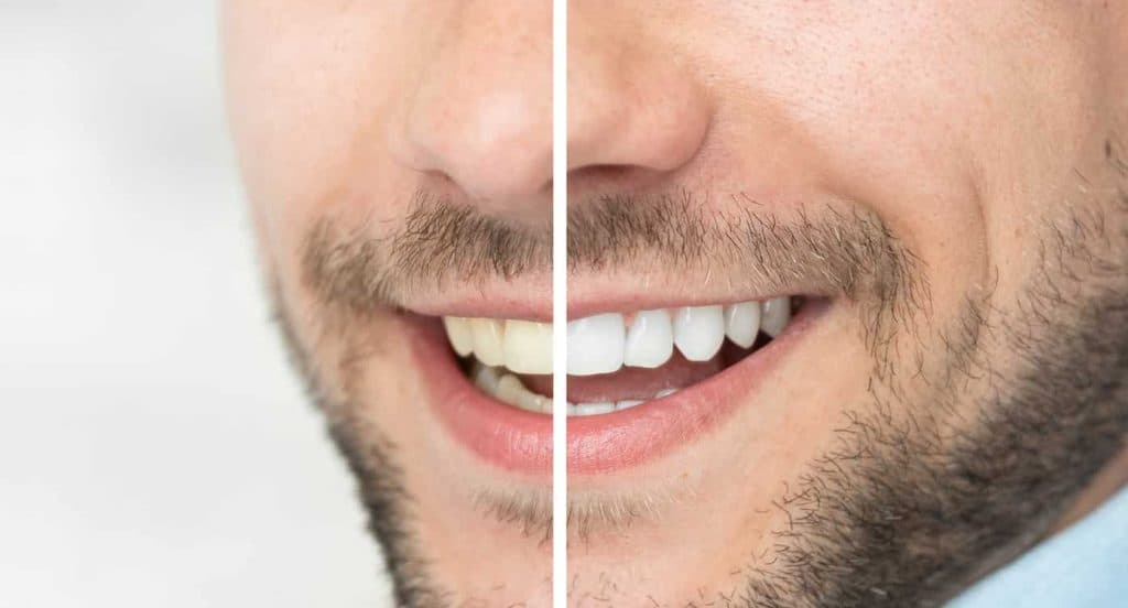 Teeth Whitening Bedfordshire Aylesbury