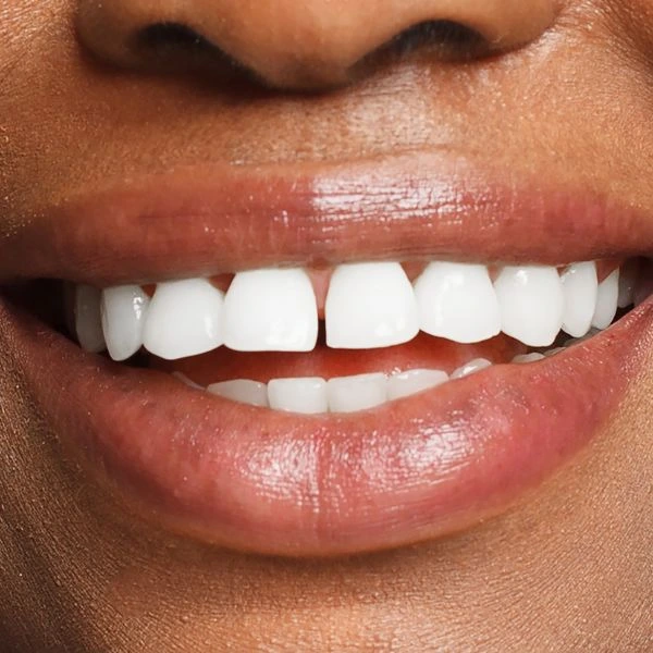 Whiter teeth in 1 hour with Blue light teeth whitening Aylesbury! Aylesbury