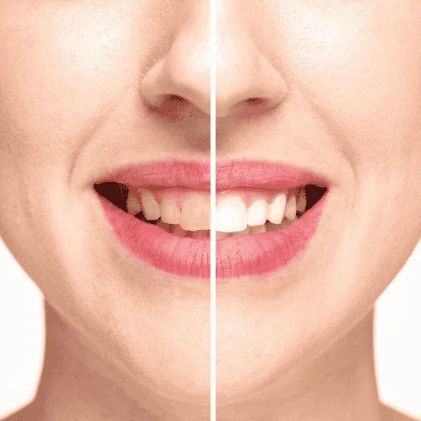 Looking for Blue light teeth whitening Aylesbury? Book in today! Aylesbury