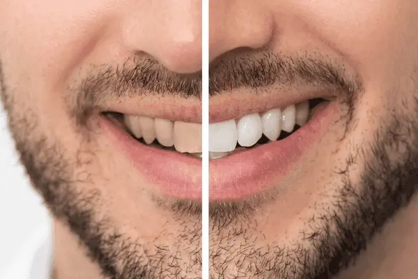 Do you want whiter teeth in just 1 hour? Book your zoom teeth whitening today Aylesbury
